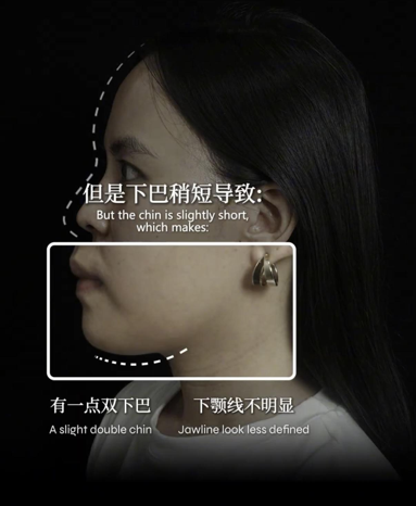 顾客接受下巴注射前的侧脸分析