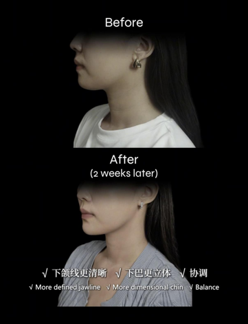 下巴设计前与注射两周后的完整对比